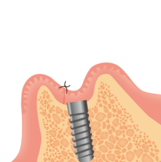 インプラント縫い合わせ