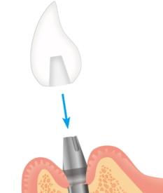 インプラント上部構造装着