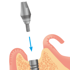 インプラントアバットメント装着