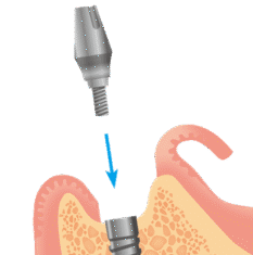 インプラントアバットメント装着