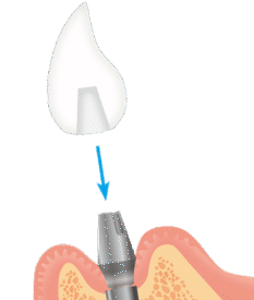 インプラント上部構造装着