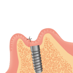 インプラント縫い合わせ
